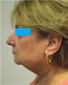 Facelift Before Photo by Jonathan Hall, MD; Stoneham, MA - Case 27115