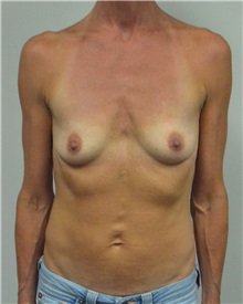 Breast Augmentation Before Photo by Jonathan Hall, MD; Stoneham, MA - Case 27118