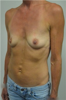 Breast Augmentation Before Photo by Jonathan Hall, MD; Stoneham, MA - Case 27118