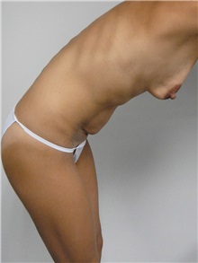 Tummy Tuck Before Photo by Jonathan Hall, MD; Stoneham, MA - Case 27119