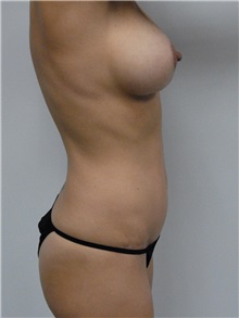 Tummy Tuck After Photo by Jonathan Hall, MD; Stoneham, MA - Case 27119