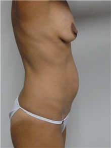 Tummy Tuck Before Photo by Jonathan Hall, MD; Stoneham, MA - Case 27119