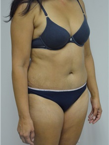 Tummy Tuck After Photo by Jonathan Hall, MD; Stoneham, MA - Case 27120