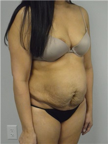 Tummy Tuck Before Photo by Jonathan Hall, MD; Stoneham, MA - Case 27120
