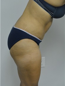 Tummy Tuck After Photo by Jonathan Hall, MD; Stoneham, MA - Case 27120
