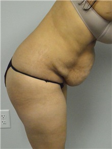 Tummy Tuck Before Photo by Jonathan Hall, MD; Stoneham, MA - Case 27120