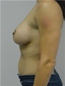 Breast Augmentation After Photo by Jonathan Hall, MD; Stoneham, MA - Case 27121