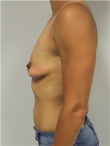 Breast Augmentation Before Photo by Jonathan Hall, MD; Stoneham, MA - Case 27121