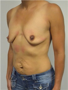 Breast Augmentation Before Photo by Jonathan Hall, MD; Stoneham, MA - Case 27121