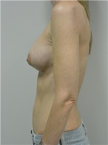 Breast Augmentation After Photo by Jonathan Hall, MD; Stoneham, MA - Case 27155