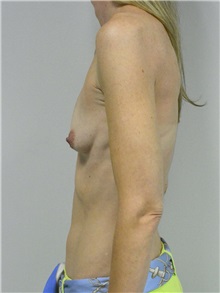 Breast Augmentation Before Photo by Jonathan Hall, MD; Stoneham, MA - Case 27155