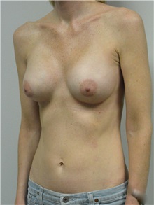 Breast Augmentation After Photo by Jonathan Hall, MD; Stoneham, MA - Case 27155