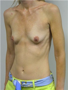 Breast Augmentation Before Photo by Jonathan Hall, MD; Stoneham, MA - Case 27155