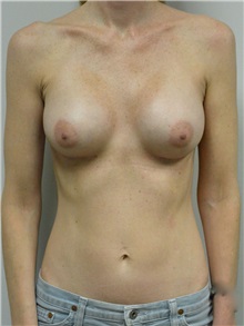 Breast Augmentation After Photo by Jonathan Hall, MD; Stoneham, MA - Case 27155