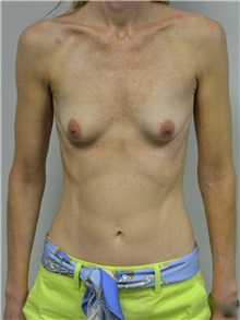 Breast Augmentation Before Photo by Jonathan Hall, MD; Stoneham, MA - Case 27155