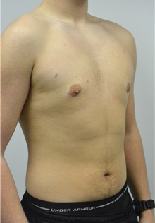 Male Breast Reduction After Photo by Jonathan Hall, MD; Stoneham, MA - Case 27183