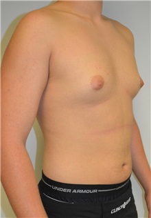 Male Breast Reduction Before Photo by Jonathan Hall, MD; Stoneham, MA - Case 27183