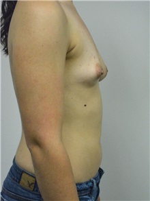 Breast Augmentation Before Photo by Jonathan Hall, MD; Stoneham, MA - Case 27407