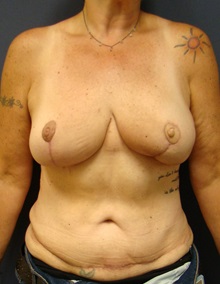Breast Reconstruction After Photo by Noel Natoli, MD, FACS; East Hills, NY - Case 30419