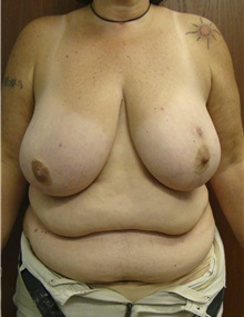 Breast Reconstruction Before Photo by Noel Natoli, MD, FACS; East Hills, NY - Case 30419