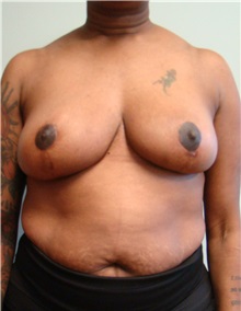 Breast Reduction After Photo by Noel Natoli, MD, FACS; East Hills, NY - Case 30422
