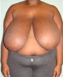 Breast Reduction Before Photo by Noel Natoli, MD, FACS; East Hills, NY - Case 30424