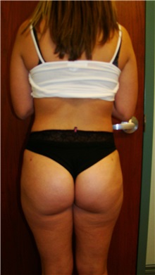 Buttock Lift with Augmentation After Photo by Noel Natoli, MD, FACS; East Hills, NY - Case 30425