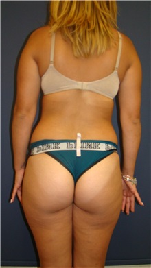 Buttock Lift with Augmentation Before Photo by Noel Natoli, MD, FACS; East Hills, NY - Case 30425