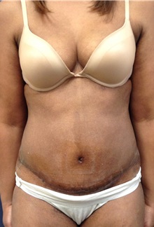 Tummy Tuck After Photo by Noel Natoli, MD, FACS; East Hills, NY - Case 30426