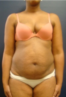 Tummy Tuck Before Photo by Noel Natoli, MD, FACS; East Hills, NY - Case 30426