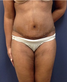 Liposuction After Photo by Noel Natoli, MD, FACS; East Hills, NY - Case 30427