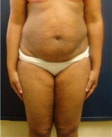 Liposuction Before Photo by Noel Natoli, MD, FACS; East Hills, NY - Case 30427