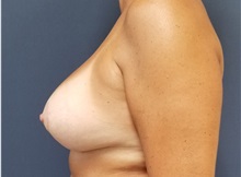 Breast Reconstruction After Photo by Noel Natoli, MD, FACS; East Hills, NY - Case 35248