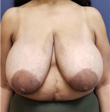 Breast Reduction Before Photo by Noel Natoli, MD, FACS; East Hills, NY - Case 35249