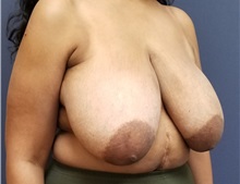 Breast Reduction Before Photo by Noel Natoli, MD, FACS; East Hills, NY - Case 35249