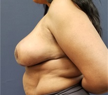 Breast Reduction After Photo by Noel Natoli, MD, FACS; East Hills, NY - Case 35249