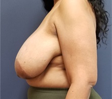 Breast Reduction Before Photo by Noel Natoli, MD, FACS; East Hills, NY - Case 35249