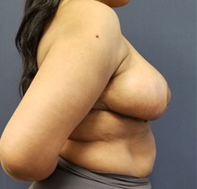Breast Reduction After Photo by Noel Natoli, MD, FACS; East Hills, NY - Case 35249