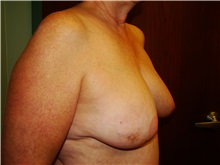 Breast Reconstruction Before Photo by Noel Natoli, MD, FACS; East Hills, NY - Case 36184