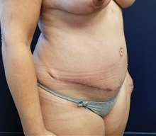 Tummy Tuck After Photo by Noel Natoli, MD, FACS; East Hills, NY - Case 36188