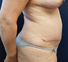 Tummy Tuck After Photo by Noel Natoli, MD, FACS; East Hills, NY - Case 36188