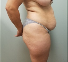 Tummy Tuck Before Photo by Noel Natoli, MD, FACS; East Hills, NY - Case 36188
