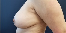 Breast Lift After Photo by Noel Natoli, MD, FACS; East Hills, NY - Case 36220