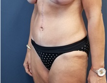 Tummy Tuck After Photo by Noel Natoli, MD, FACS; East Hills, NY - Case 36225
