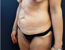 Tummy Tuck Before Photo by Noel Natoli, MD, FACS; East Hills, NY - Case 36225