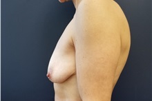 Breast Augmentation Before Photo by Noel Natoli, MD, FACS; East Hills, NY - Case 36226