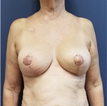 Breast Reconstruction After Photo by Noel Natoli, MD, FACS; East Hills, NY - Case 36741