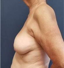Breast Reconstruction Before Photo by Noel Natoli, MD, FACS; East Hills, NY - Case 36741