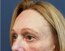 Eyelid Surgery After Photo by Noel Natoli, MD, FACS; East Hills, NY - Case 41897