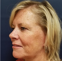 Facelift After Photo by Noel Natoli, MD, FACS; East Hills, NY - Case 41899